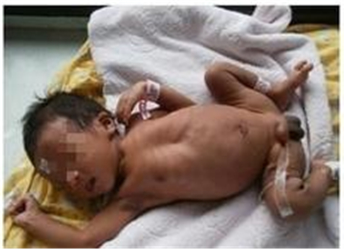 男性假兩性畸形新生兒