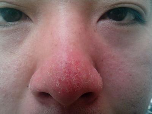 鼻子長蟎蟲症狀