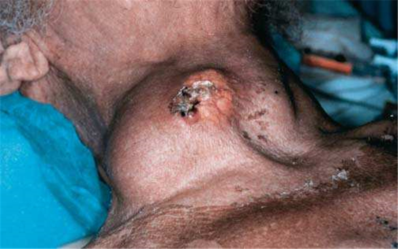 未分化甲狀腺癌