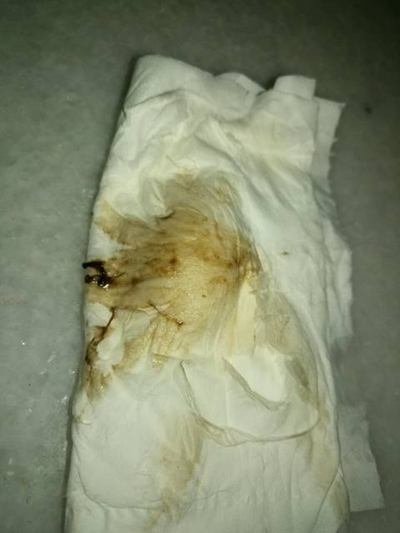 先兆流產分泌物