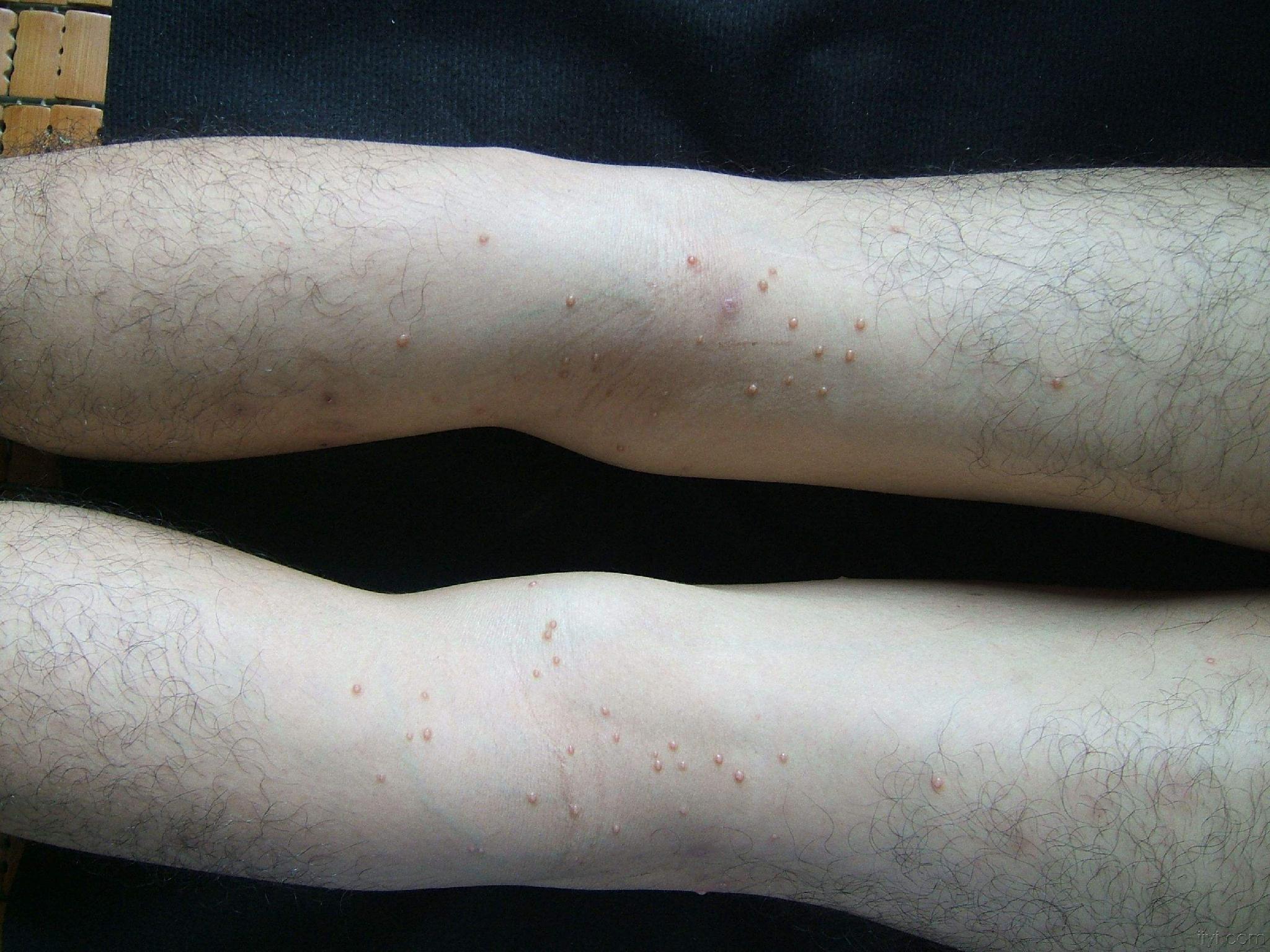 傳染性軟疣症狀 