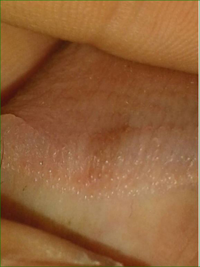 男性尖銳溼疣照片 (48) 