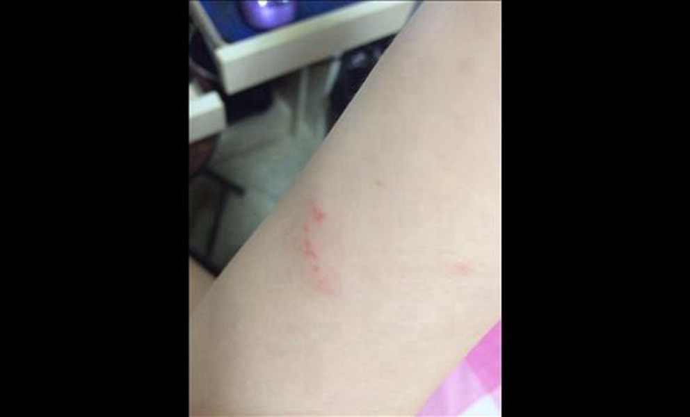 真實流感胳膊症狀