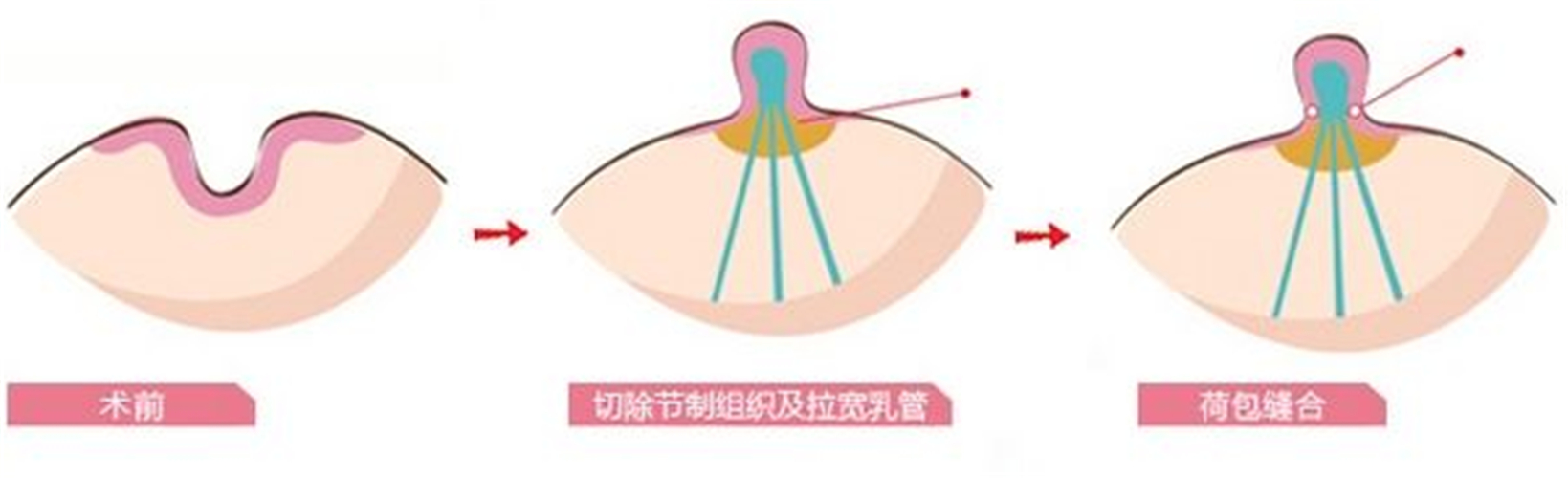 乳頭內陷治療效果
