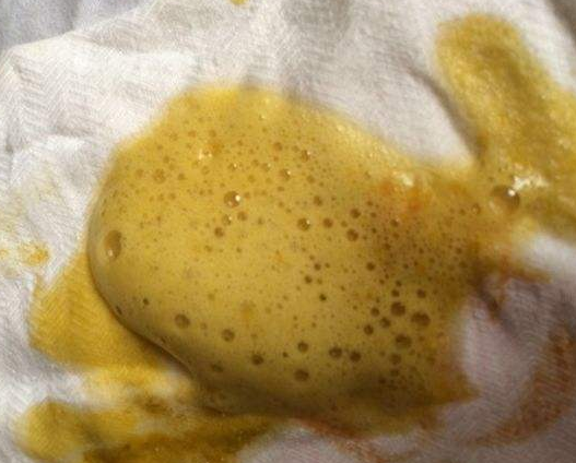 新生兒消化不良大便圖 (64) 