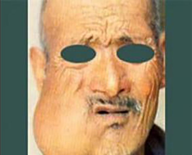 縱隔擴大的滑膜肉瘤