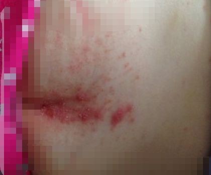 寶寶紅屁屁照片 (5) 