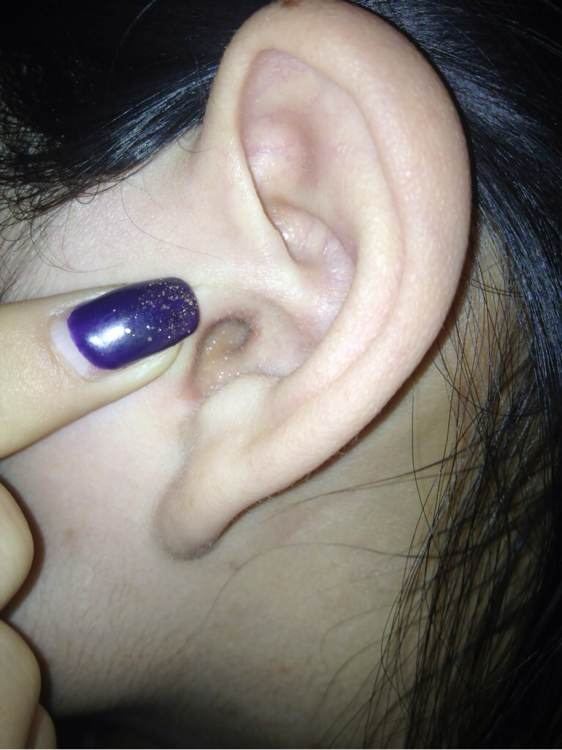 女性早期急性中耳炎