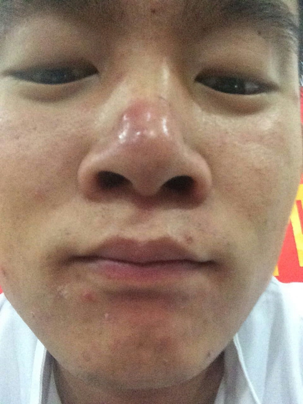 藥物性皮炎鼻子有大紅疙瘩
