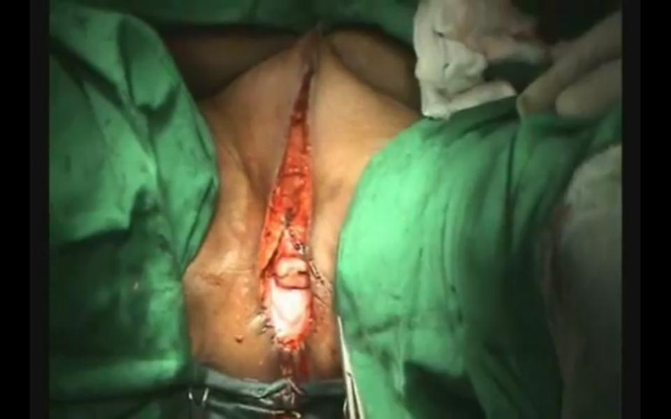 外陰癌治療手術