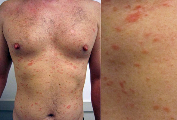 艾滋病紅疹症狀