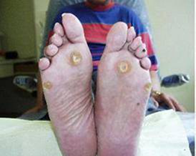 蹠疣雞眼胼胝的