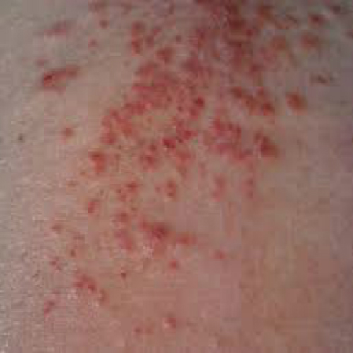 外陰溼疹炎症的