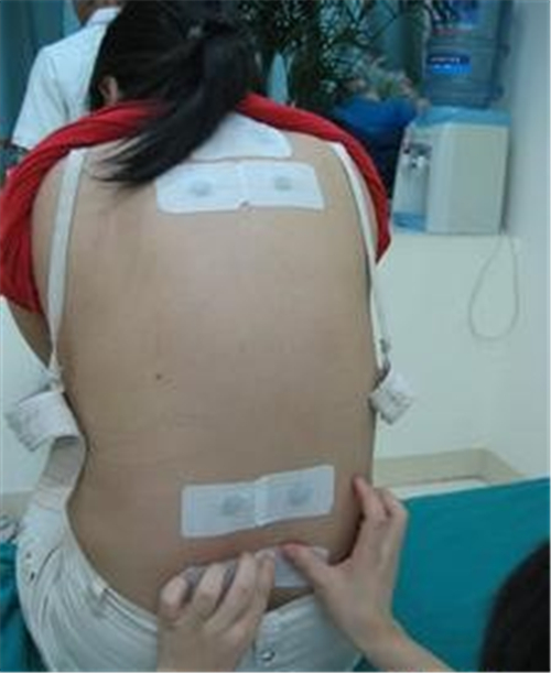 穴位貼敷治療慢性支氣管炎