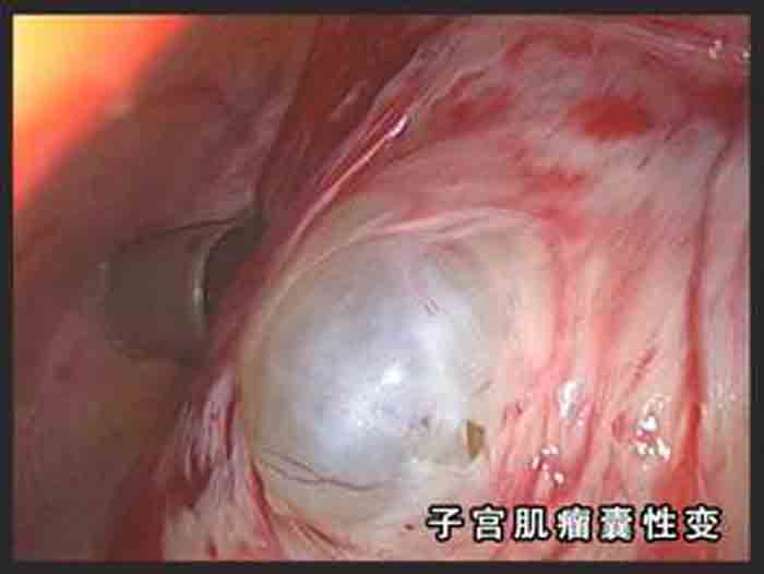 子宮肌瘤囊性變