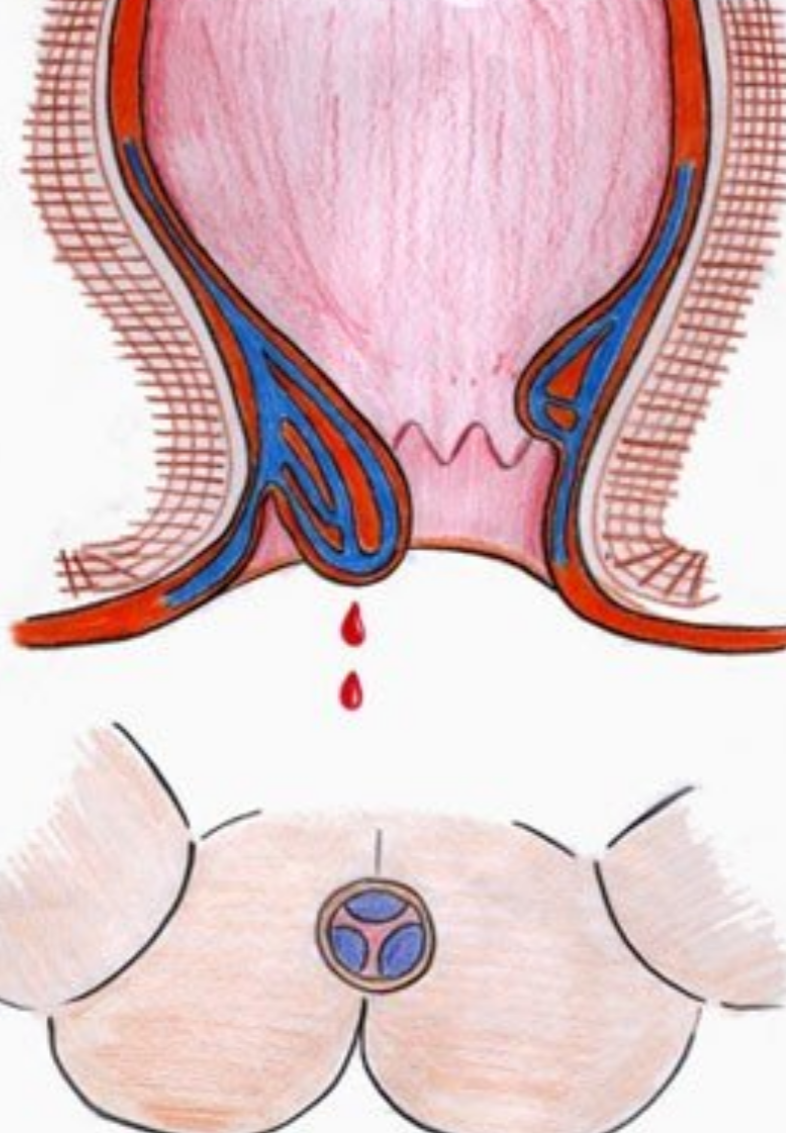 人工陰道治療前後