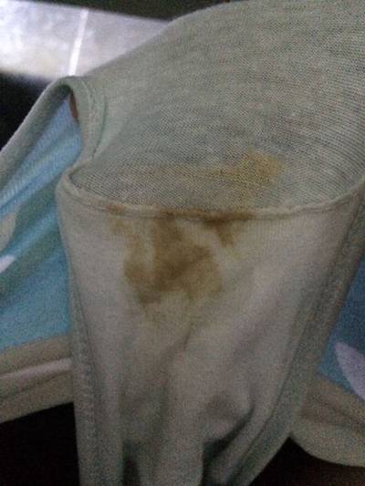 先兆流產分泌物