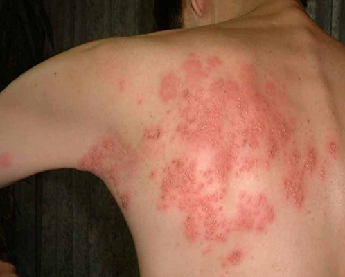 帶狀皰疹樣外觀