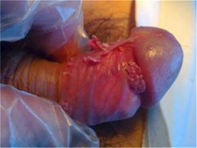 男性假性溼疣真實