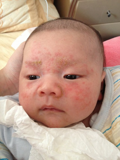 新生兒胎毒的症狀