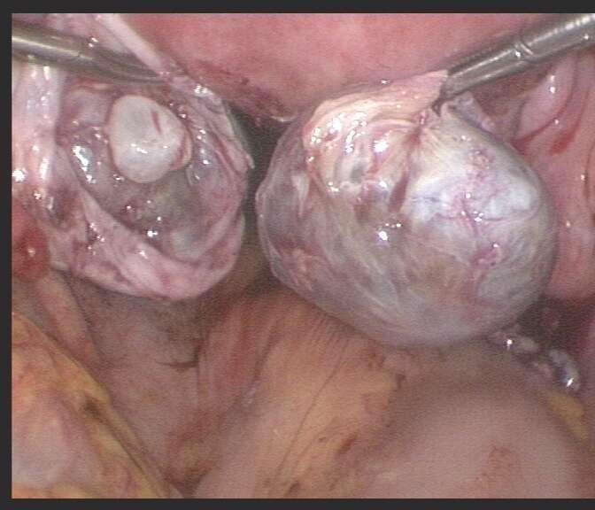 巧克力卵巢囊腫手術高清