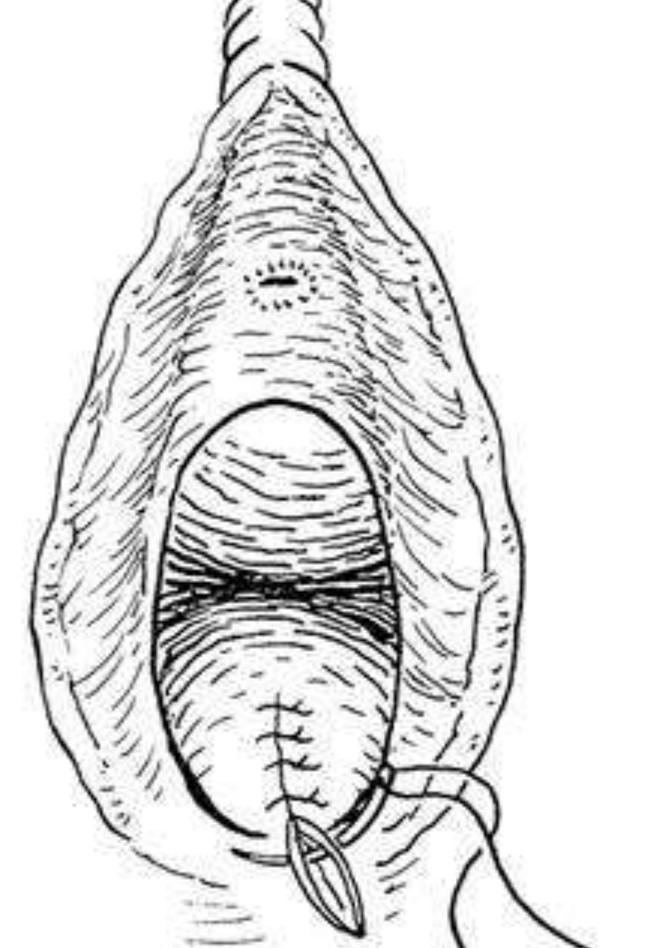 三四度會陰撕傷的