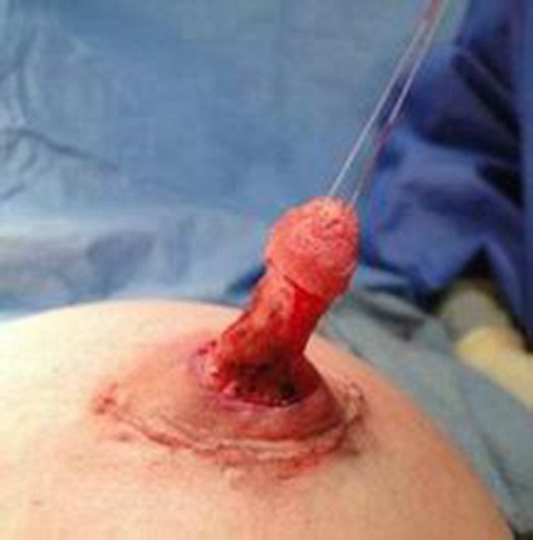 孕婦乳頭內陷圖 