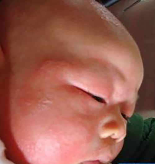 嬰兒甲狀腺腫大症狀表現