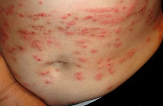 玫瑰糠疹母斑