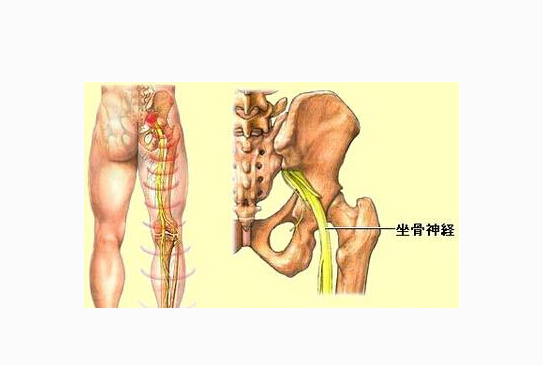 坐骨神經痛的症狀圖 (45) 