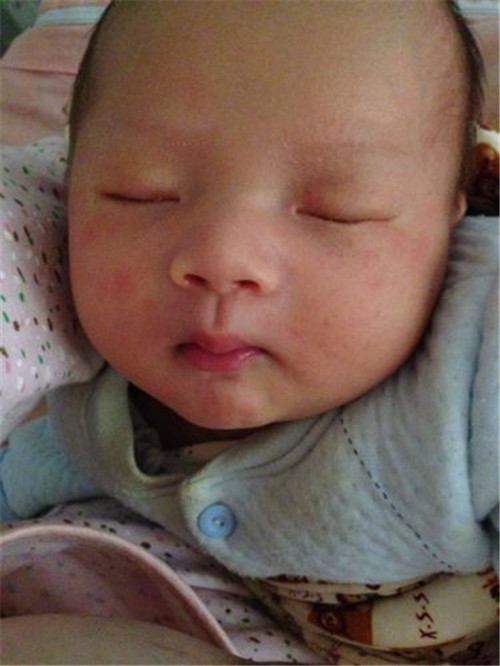 中醫治療兒童傳染性軟疣 