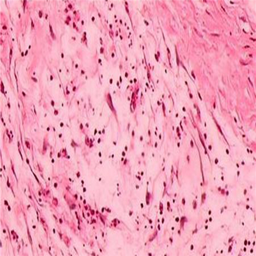 直腸息肉惡變細胞