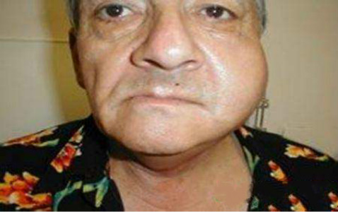 慢性淋巴結炎 (40) 