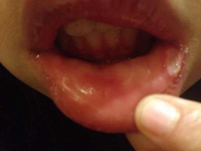 小孩字嘴邊淋巴結前期口腔發炎