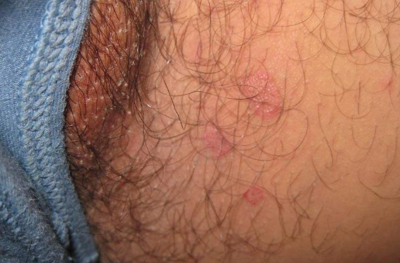 體股癬初期現象