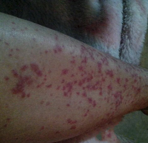 系統性紅斑狼瘡診斷標準 (41) 