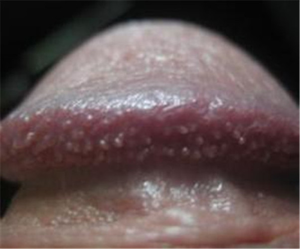 男性早期假性溼疣圖 
