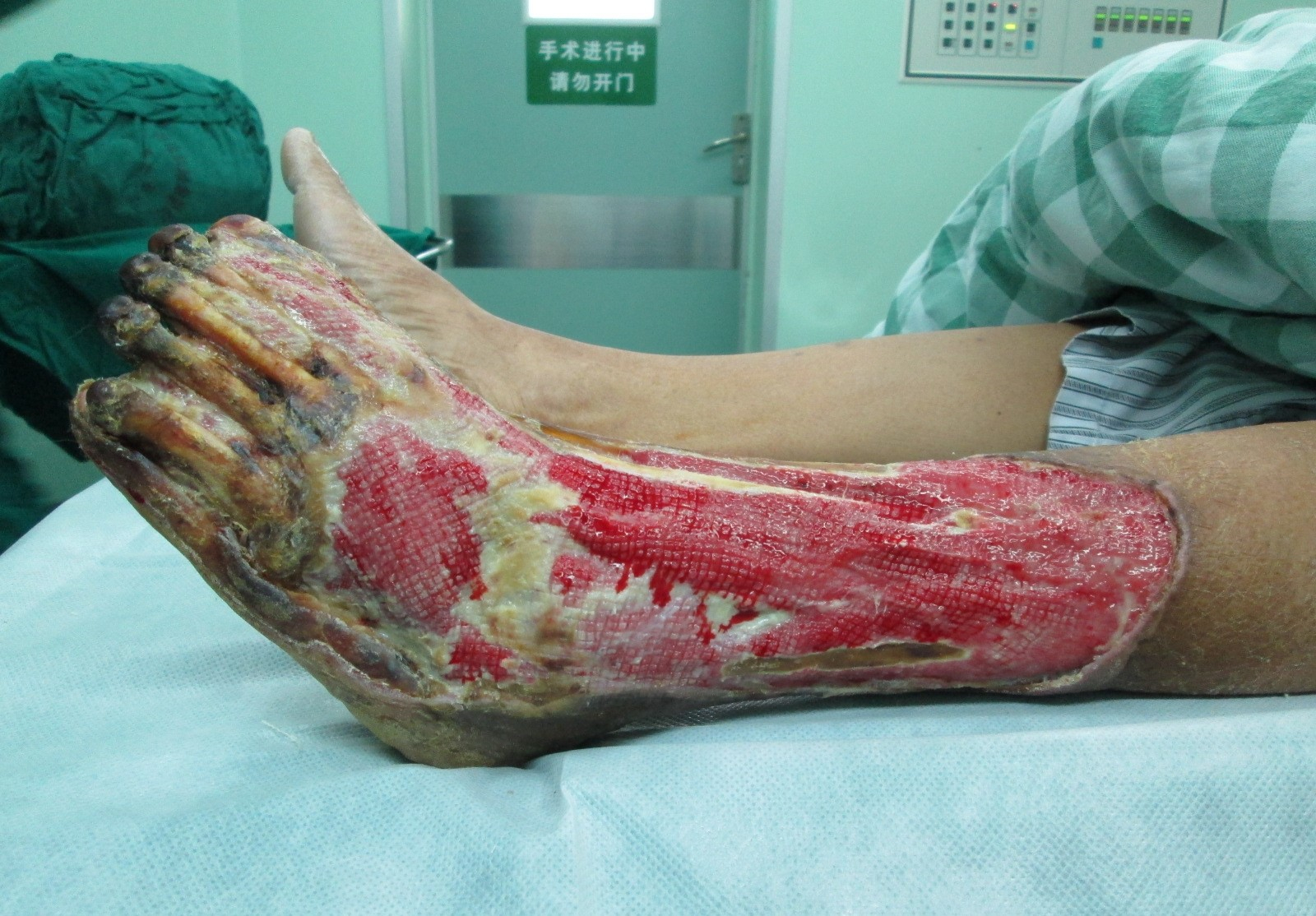 治療中的糖尿病足