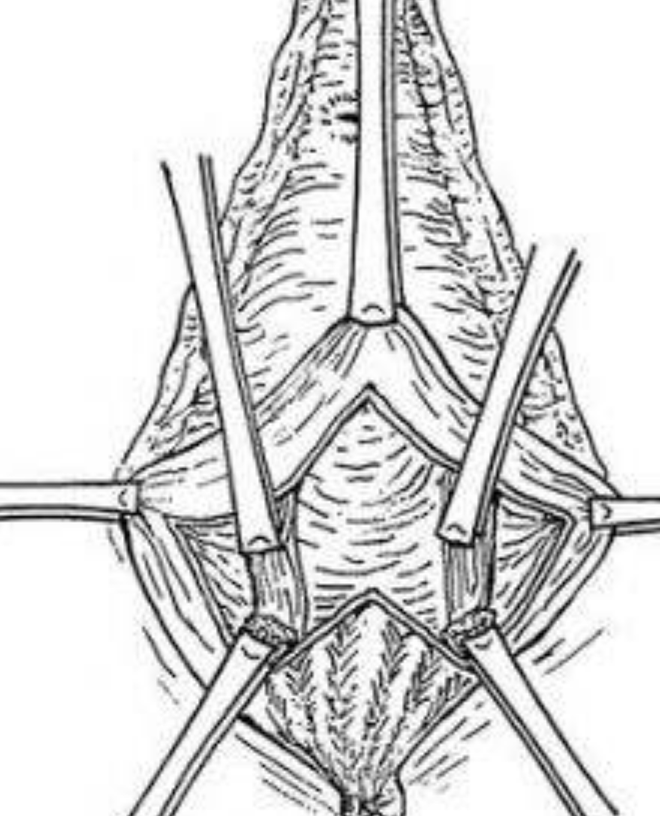 順產會陰撕裂的