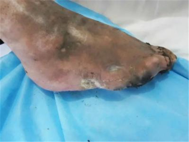 慢性骨髓炎症狀表現