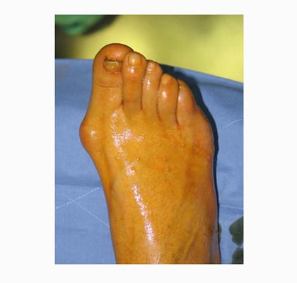 腳骨頭突出 (41) 