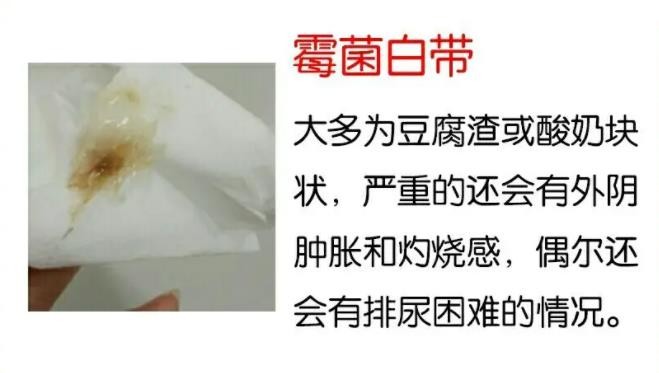 黴菌陰炎症狀 (40) 