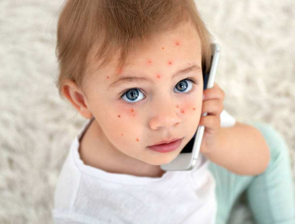 長水痘的症狀 (64) 