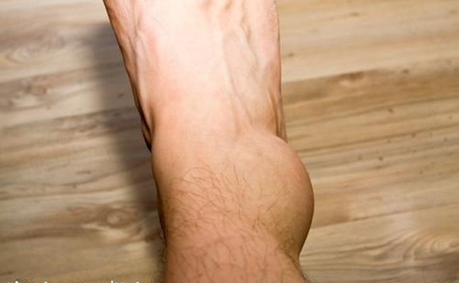 腳骨頭突出 (47) 