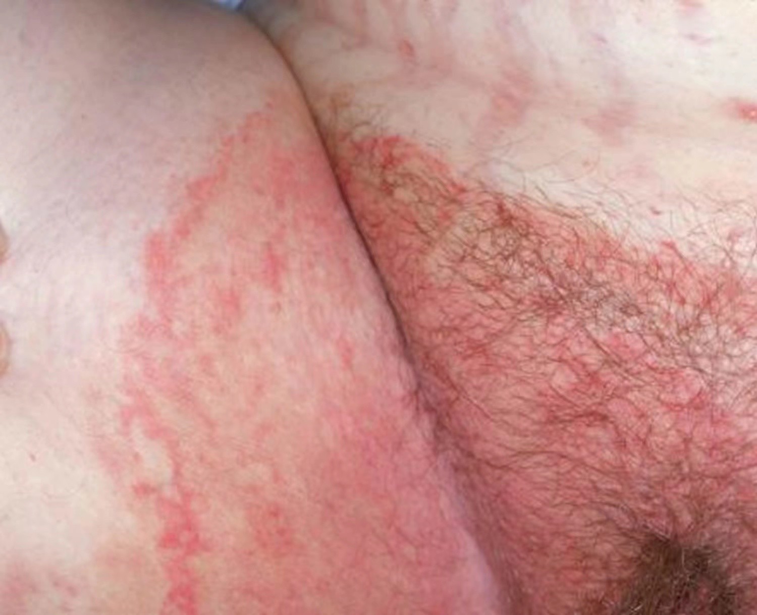 體股癬初期現象