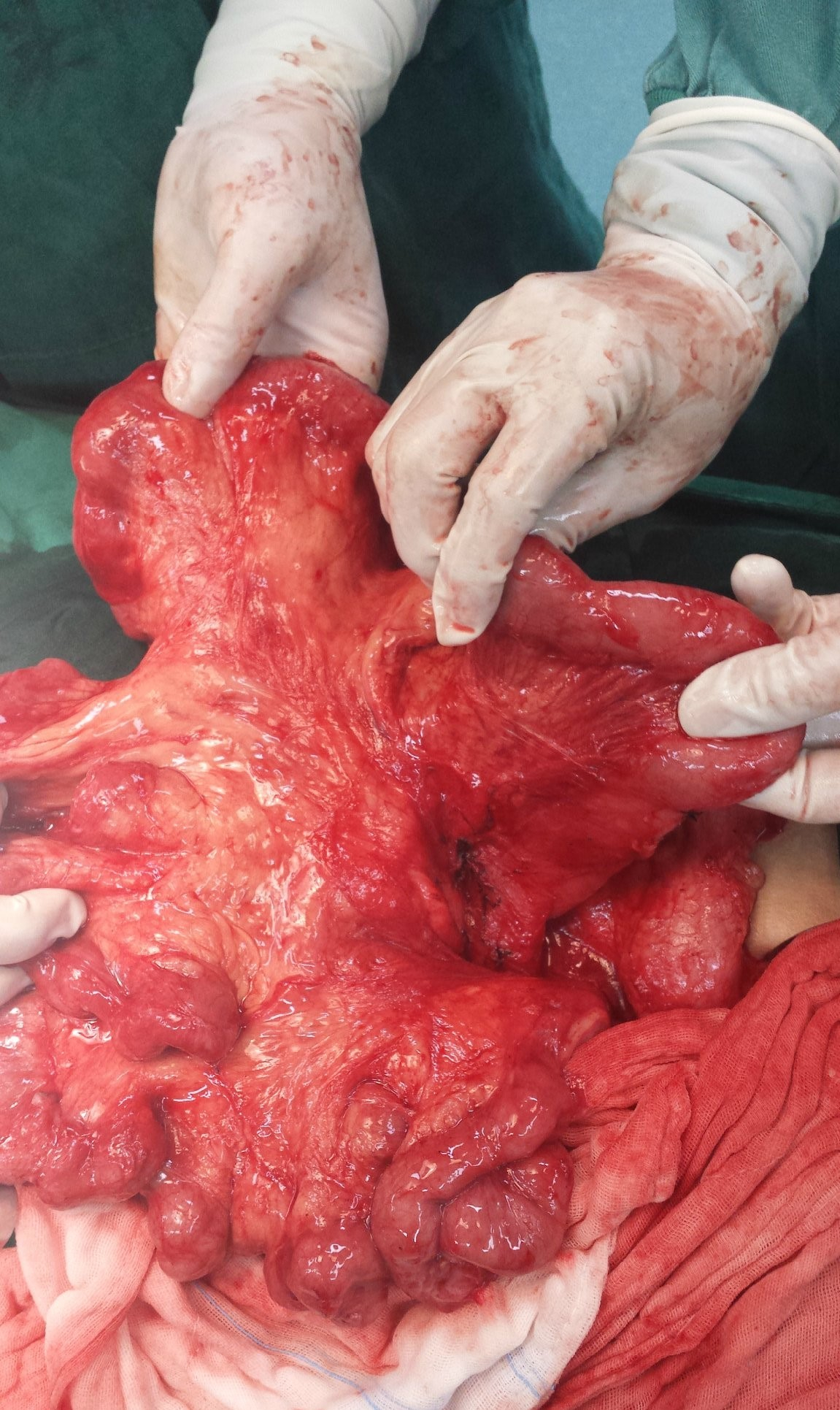 手術中的腸粘連高清