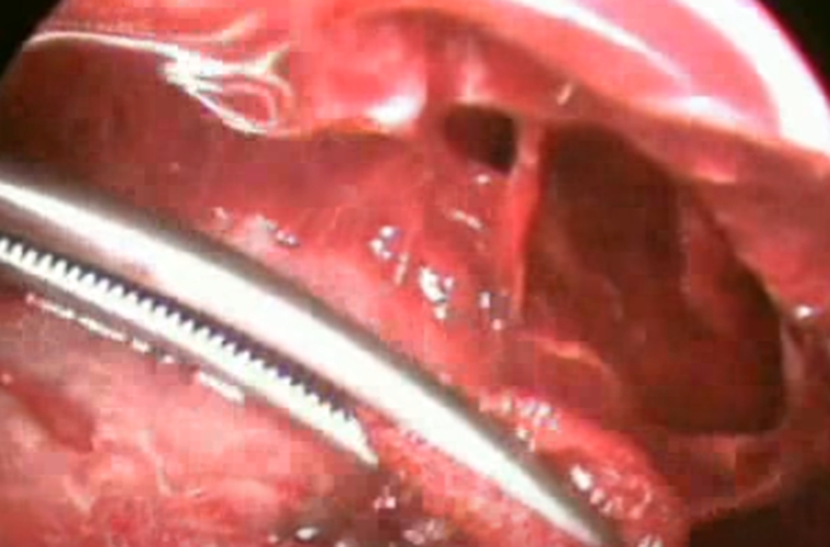 結核性胸膜炎胸腔鏡的