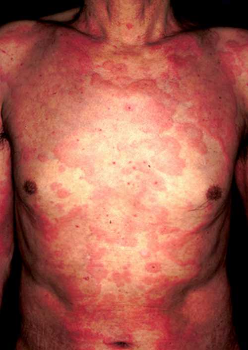 藥物性皮炎藥的