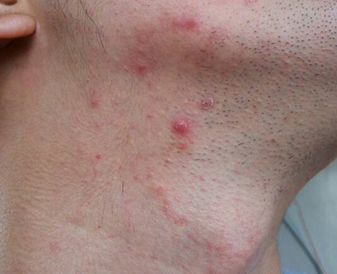 血熱的症狀痘痘