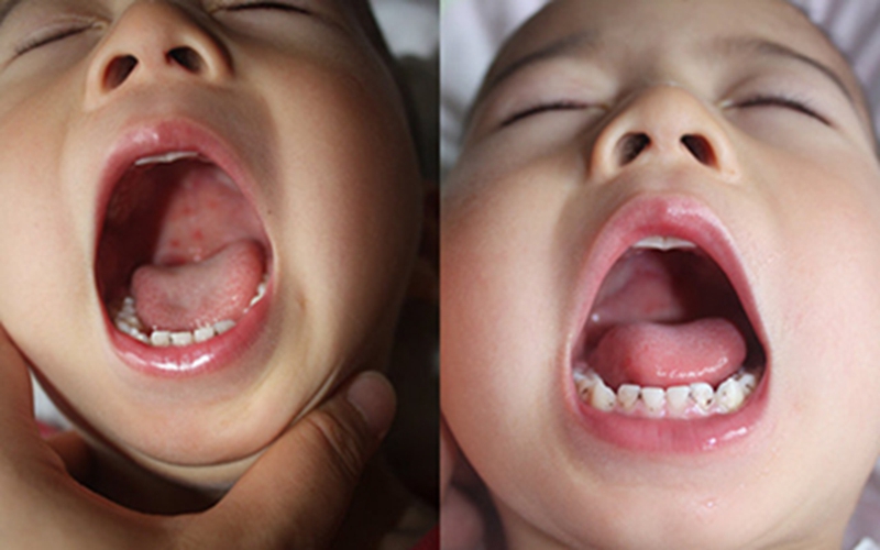 小孩的急性咽炎的